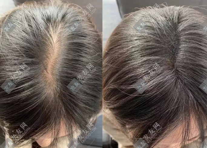 蘇玫氏頭發(fā)纖維粉使用方法